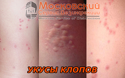 как выглядят укусы постельных клопов укусы домашних клопов постельных